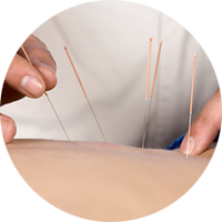 子宮や卵巣の血流をアップさせる鍼灸治療＋ラジオ波（深部温熱器）